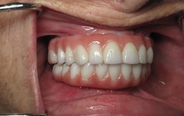 Dentures Implants Mound TX 76558